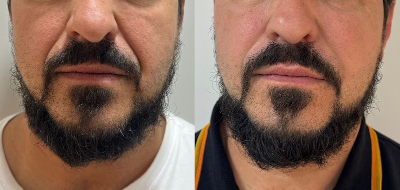 Botolifting Vitória - Harmonização e Estética Facial e Corporal - Clínica de Estética em Jardim Camburi, Vitória/ES - Foto 5