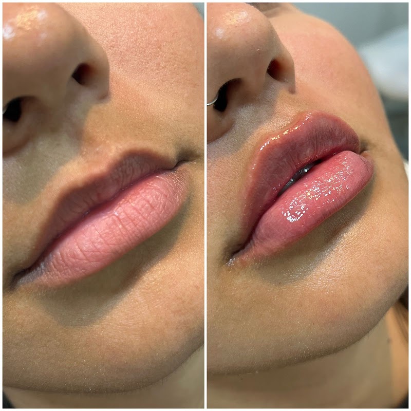 Foto 6 de Botolifting Vitória - Harmonização e Estética Facial e Corporal